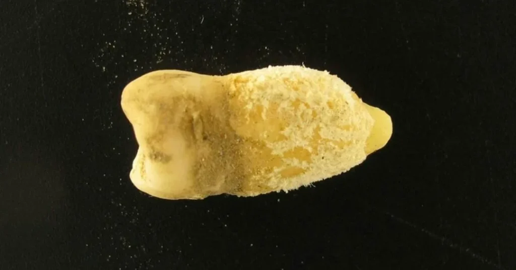 Momia boliviana con bacteria de la escarlatina
